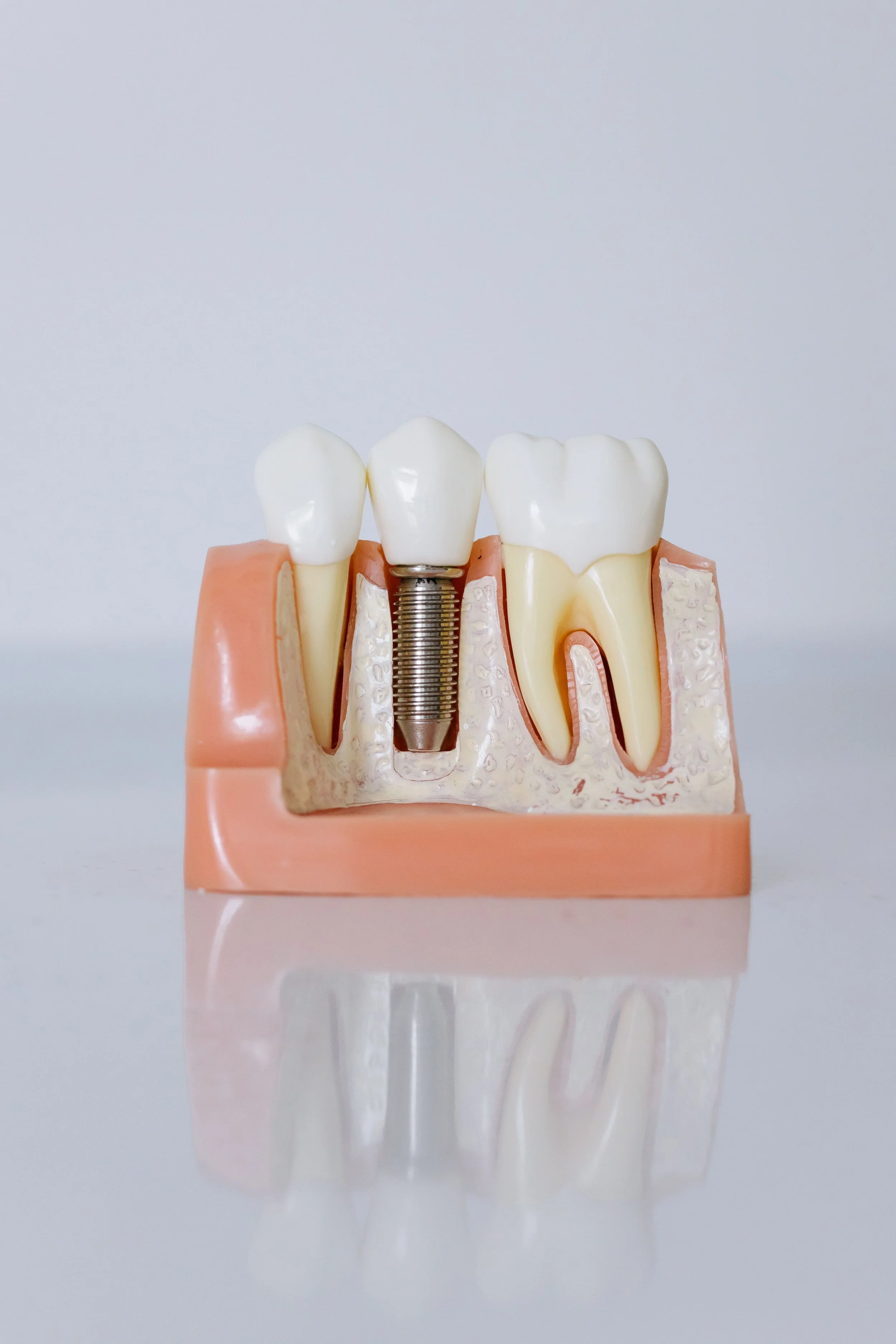 Dental Implants: A Lasting Solution for Missing Teeth