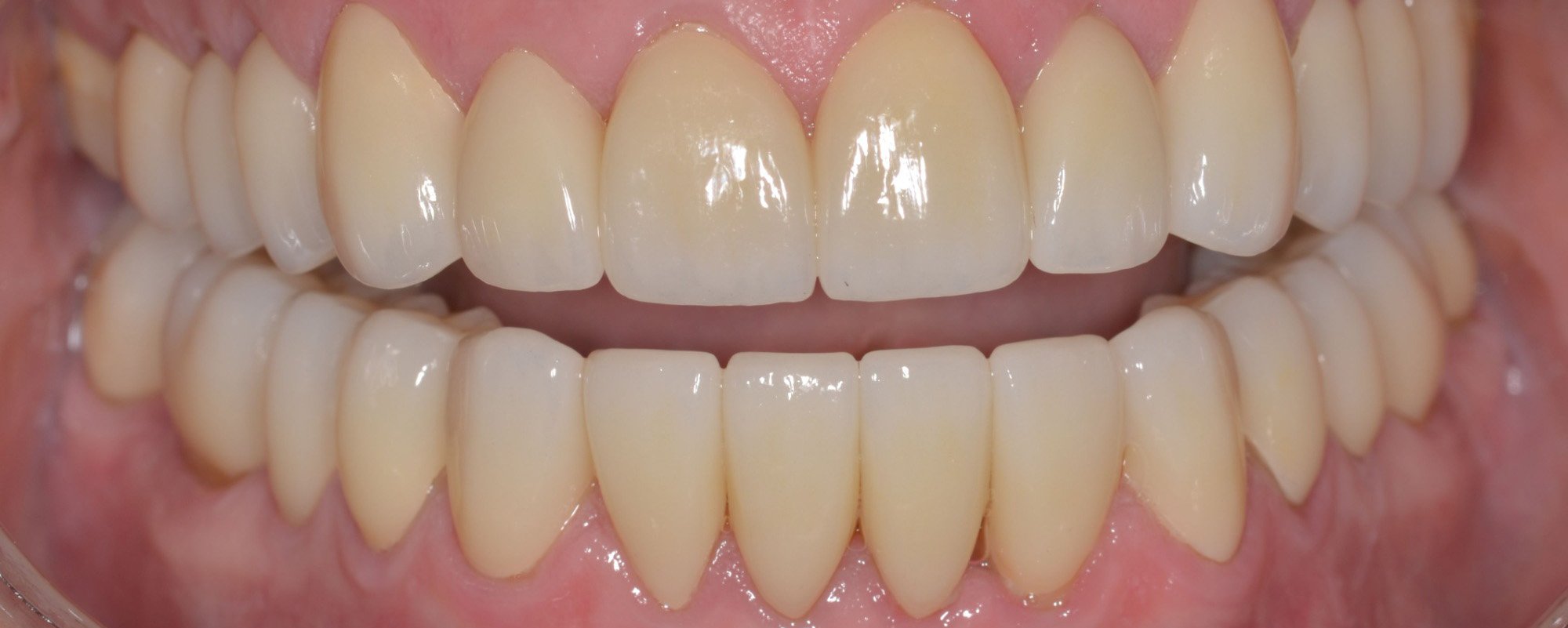 Closeup of teeth after porcelain veneers