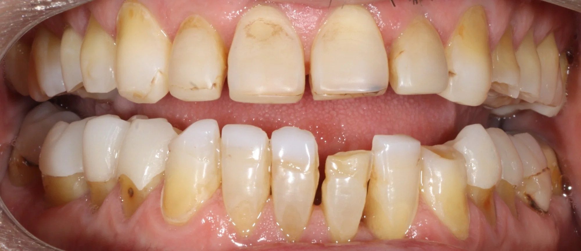 Close up of teeth before Porcelain veneers