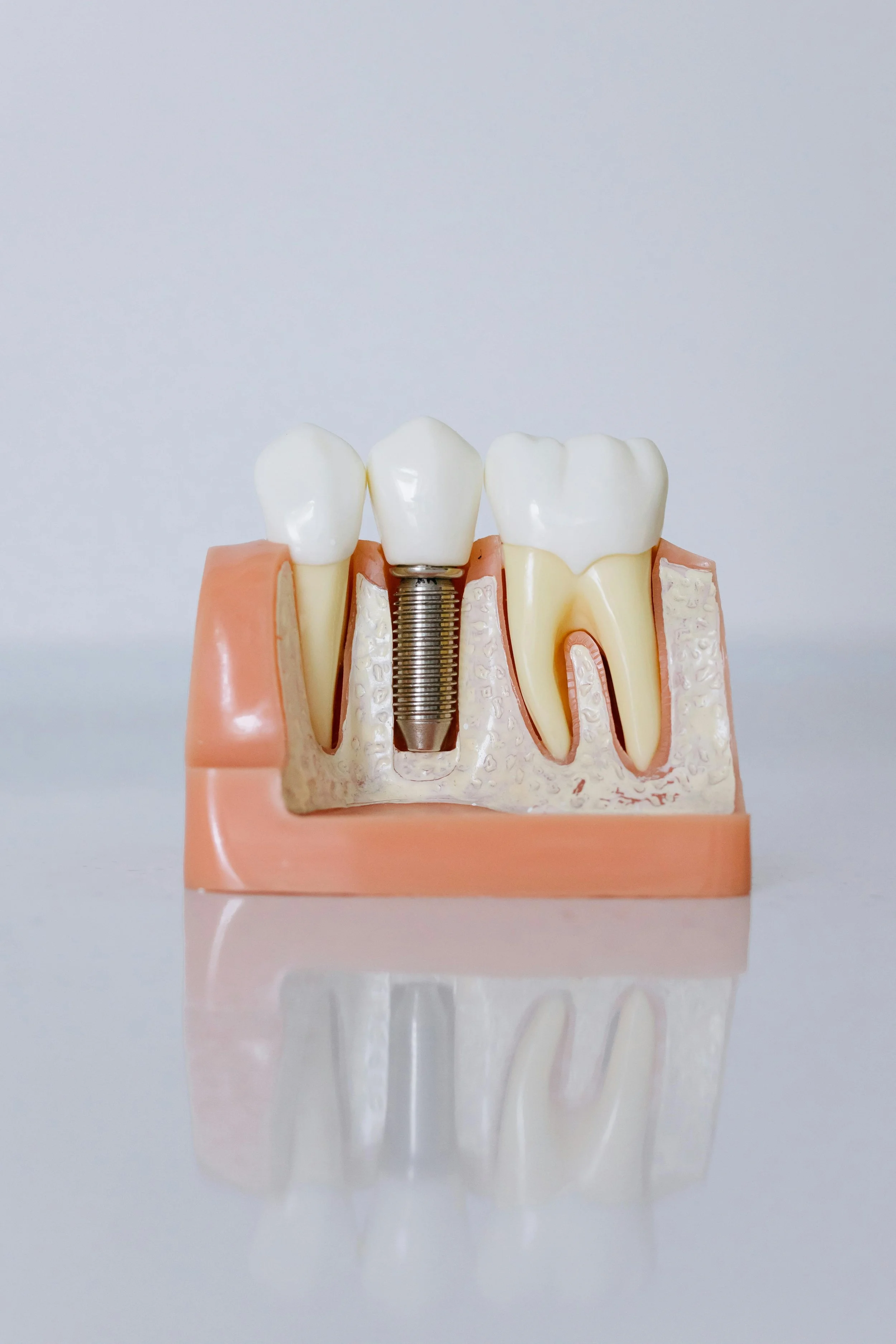 Close-up of dental implant model against a neutral background