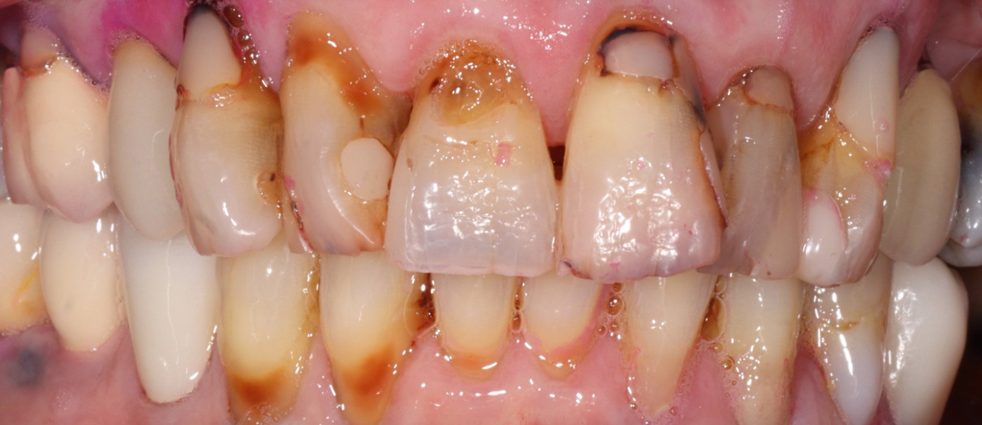 Close-up of upper teeth that are severely stained and broken down