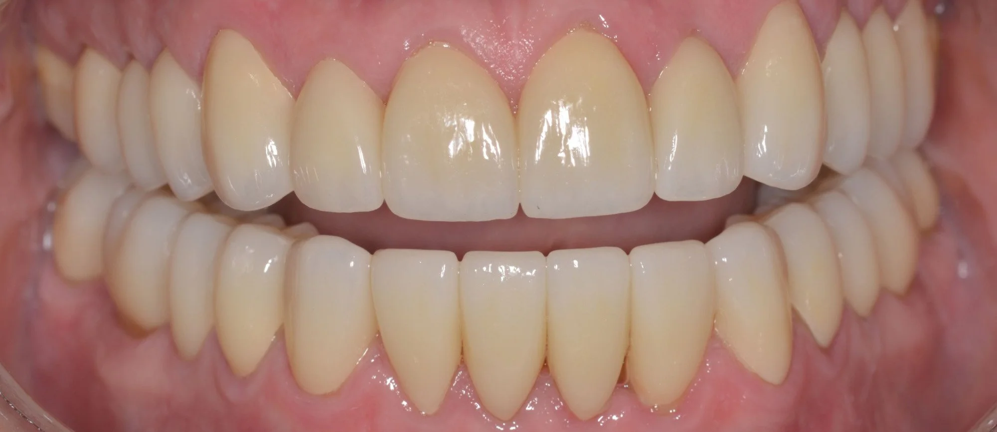 Closeup of teeth after full-mouth rehabilitation with porcelain crowns