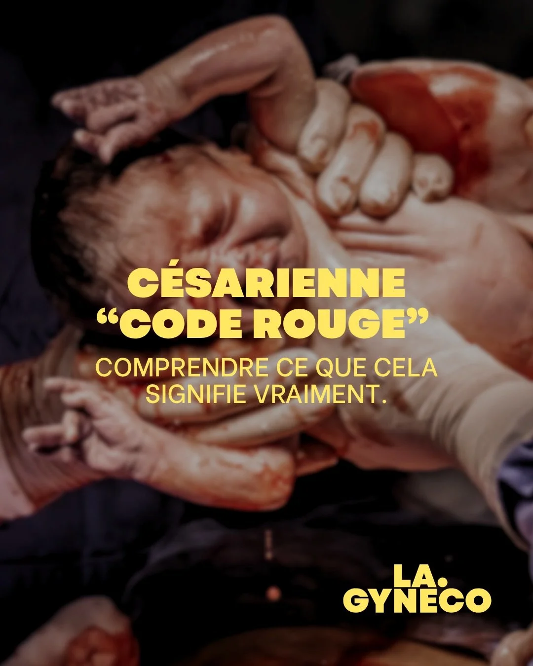 Il y a un moment particulier en salle de naissance o&ugrave; l&rsquo;on sent que &ccedil;a ne descend pas.

On pose les spatules, on accompagne la pouss&eacute;e, et puis&hellip; rien. Dans ces secondes-l&agrave;, il n&rsquo;y a plus de place pour l&
