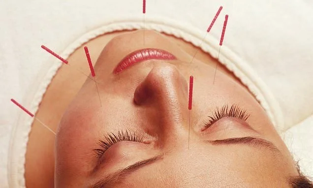 Acupuncture and Migraine Relief: A Natural Approach