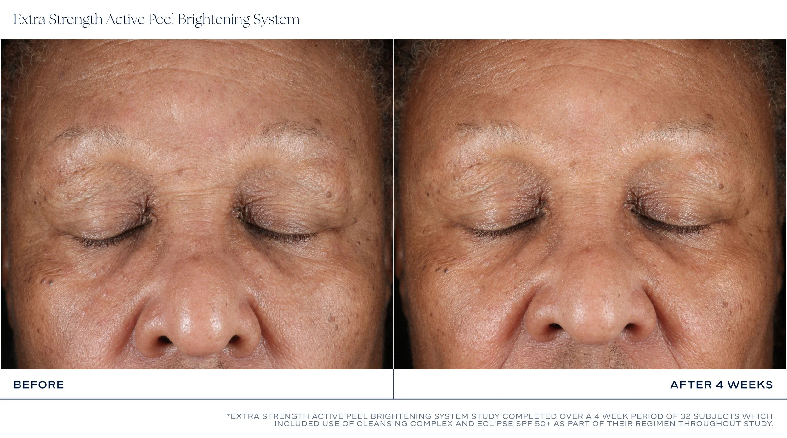 MKTG_ExtraStrengthActivePeelBrigteningSystem_BeforeAfter_4Weeks_3.jpg