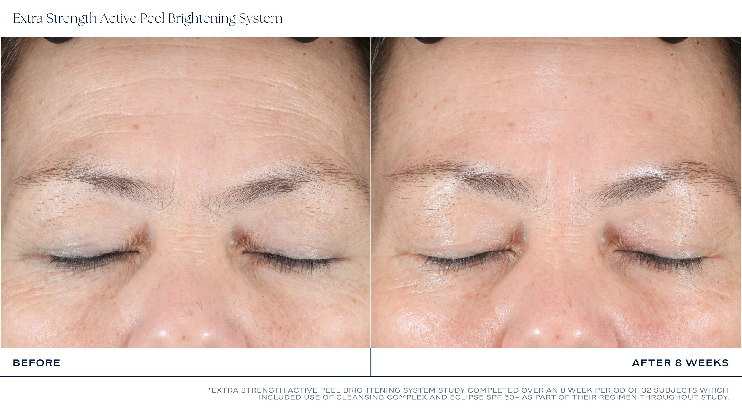 MKTG_ExtraStrengthActivePeelBrigteningSystem_BeforeAfter_8Weeks_3.jpg