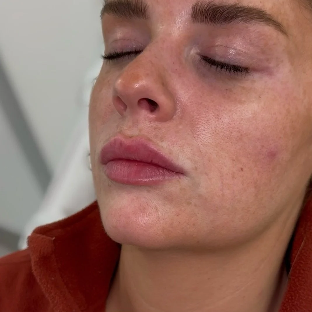 Lip filler immediately after treating 💉👄
By Dr Mishaal 
📍North London Clinic