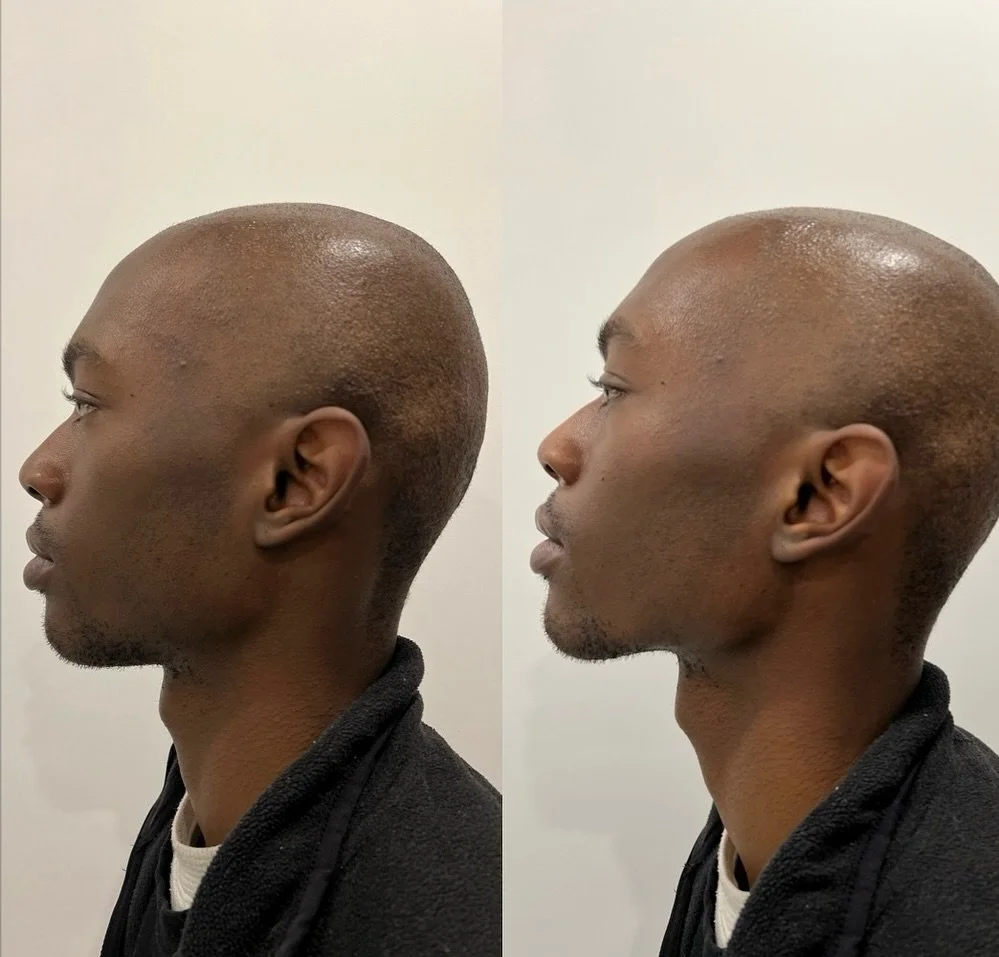 Jawline and cheek filler to create definition and structure by Dr Mishaal.