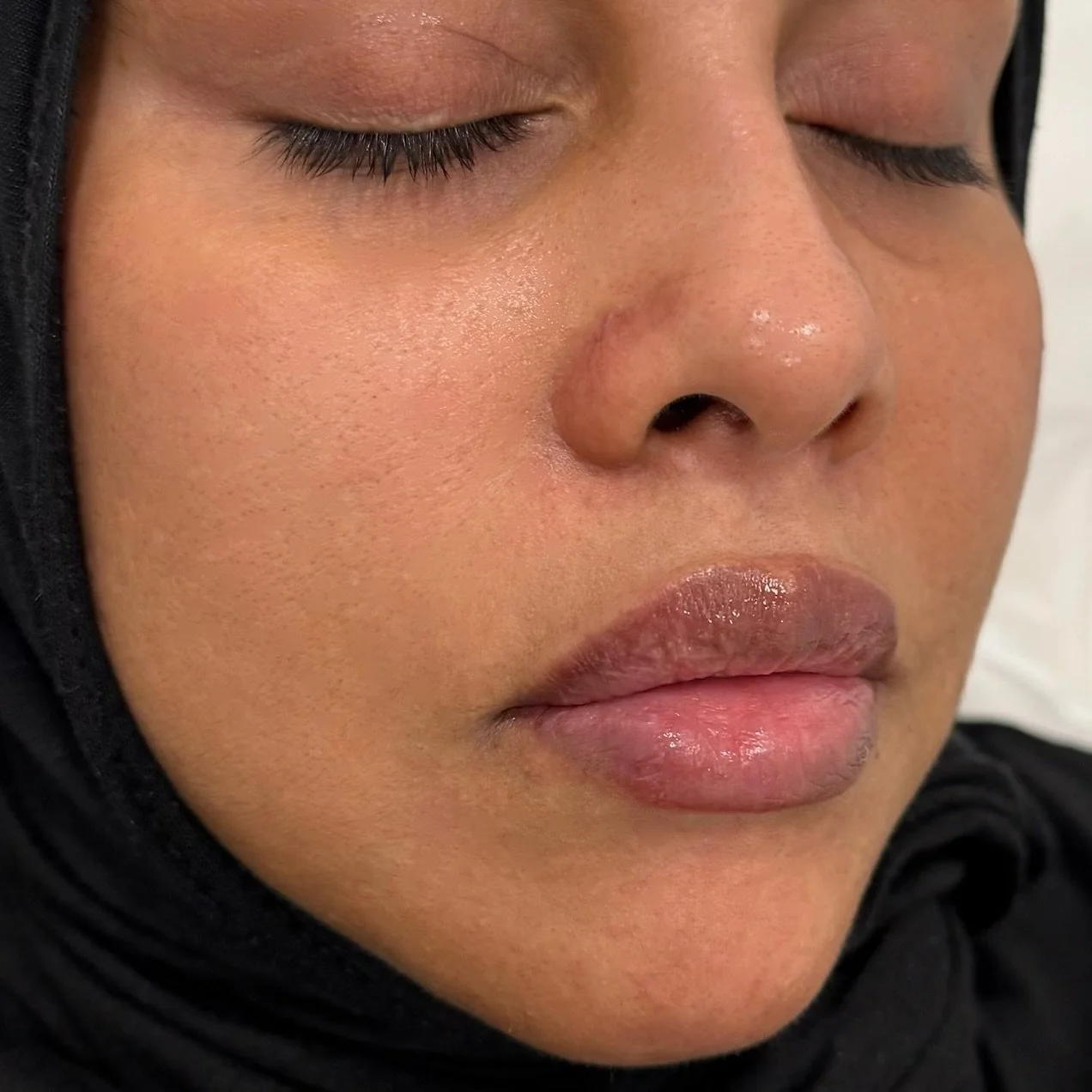 Immediately after lip filler treatment. Each patient has unique lip anatomy and therefore this treatment should be individual and tailored to everyone. 💉👄

#lipfiller #aeathetic #aesthetics #filler #botox