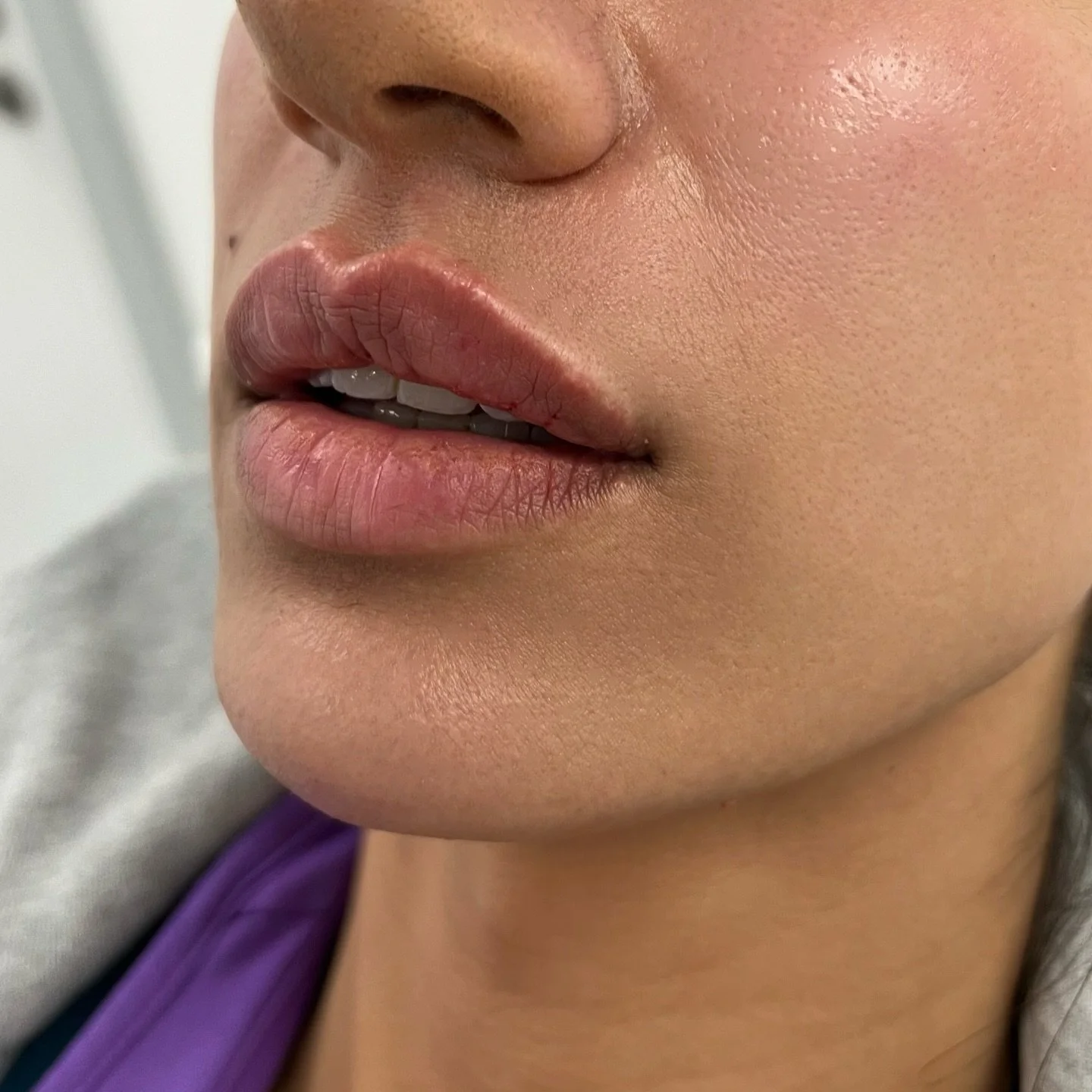 Immediately after lip filler treatment. This patient wanted to enhance her lip shape and add definition whilst also maintaining a natural result. 💉👄

#lipfiller #doctor #dentist #filler #botox