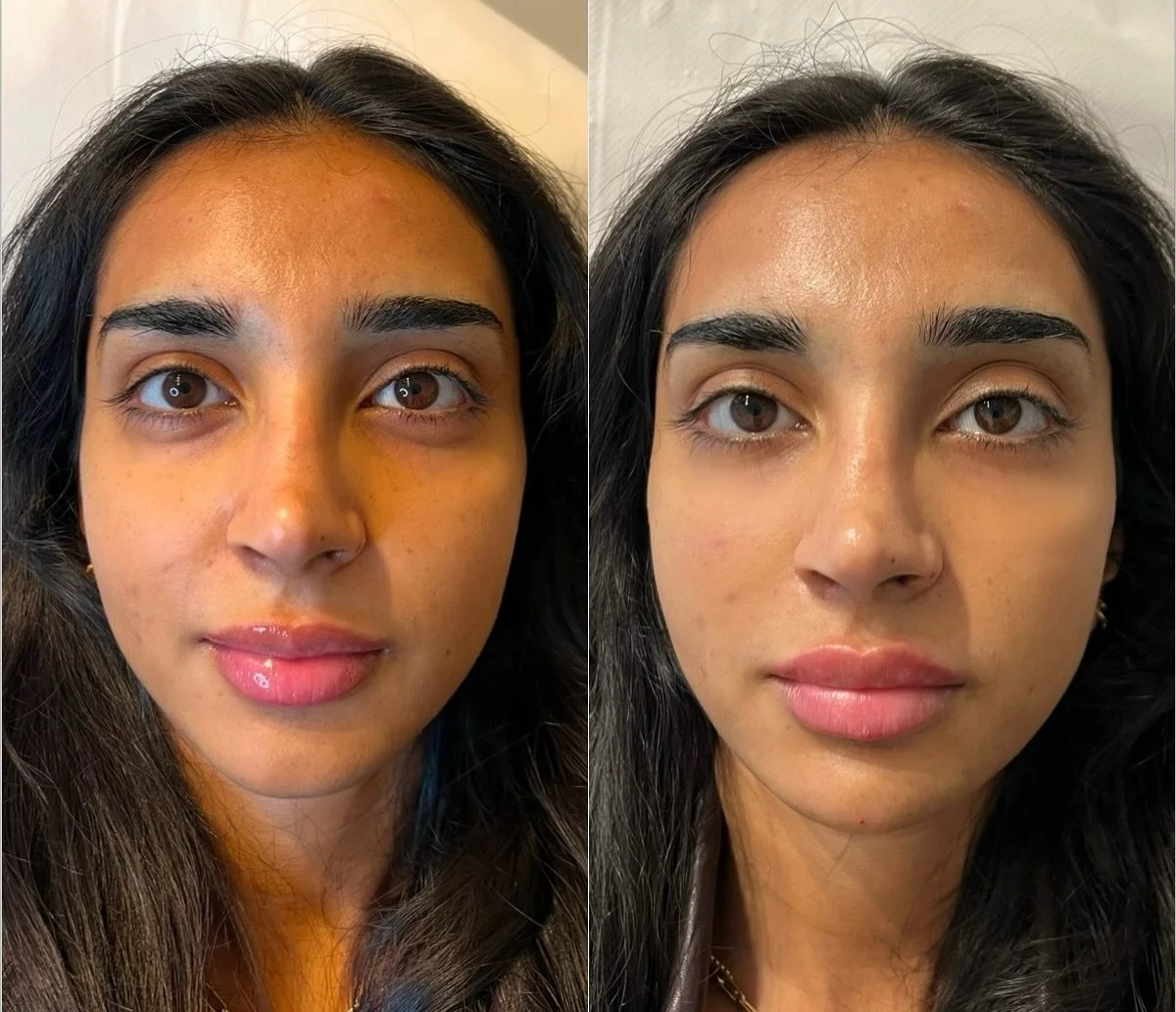 Can you guess which treatments our patients had? (Answer below)👇 

We have been treating this patient for years and treated multiple areas of the face with dermal filler. It&rsquo;s important to go to an injector that&rsquo;s going to keep you looki