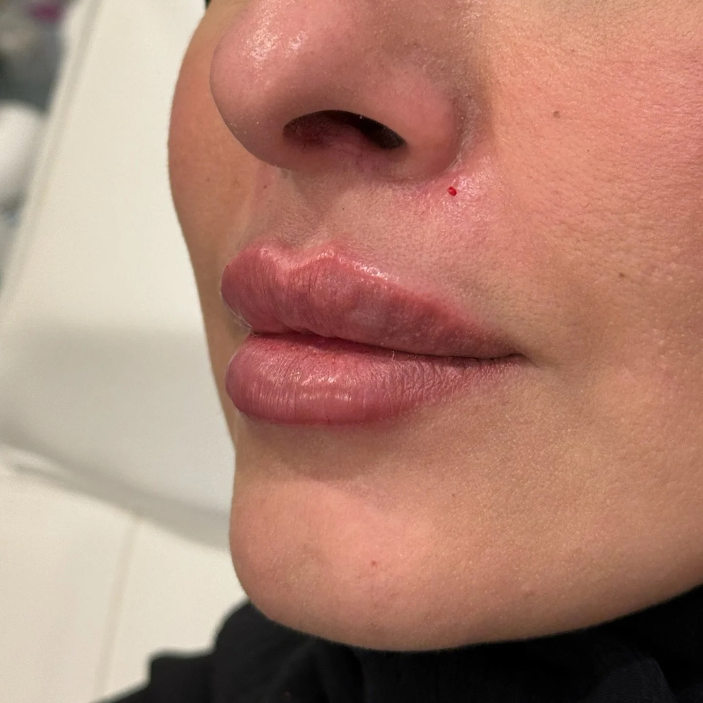 Lip filler treatment immediately after. Extremely swollen and bruised lips after lip filler isn&rsquo;t normal it all depends on the injector and technique. 👄💉