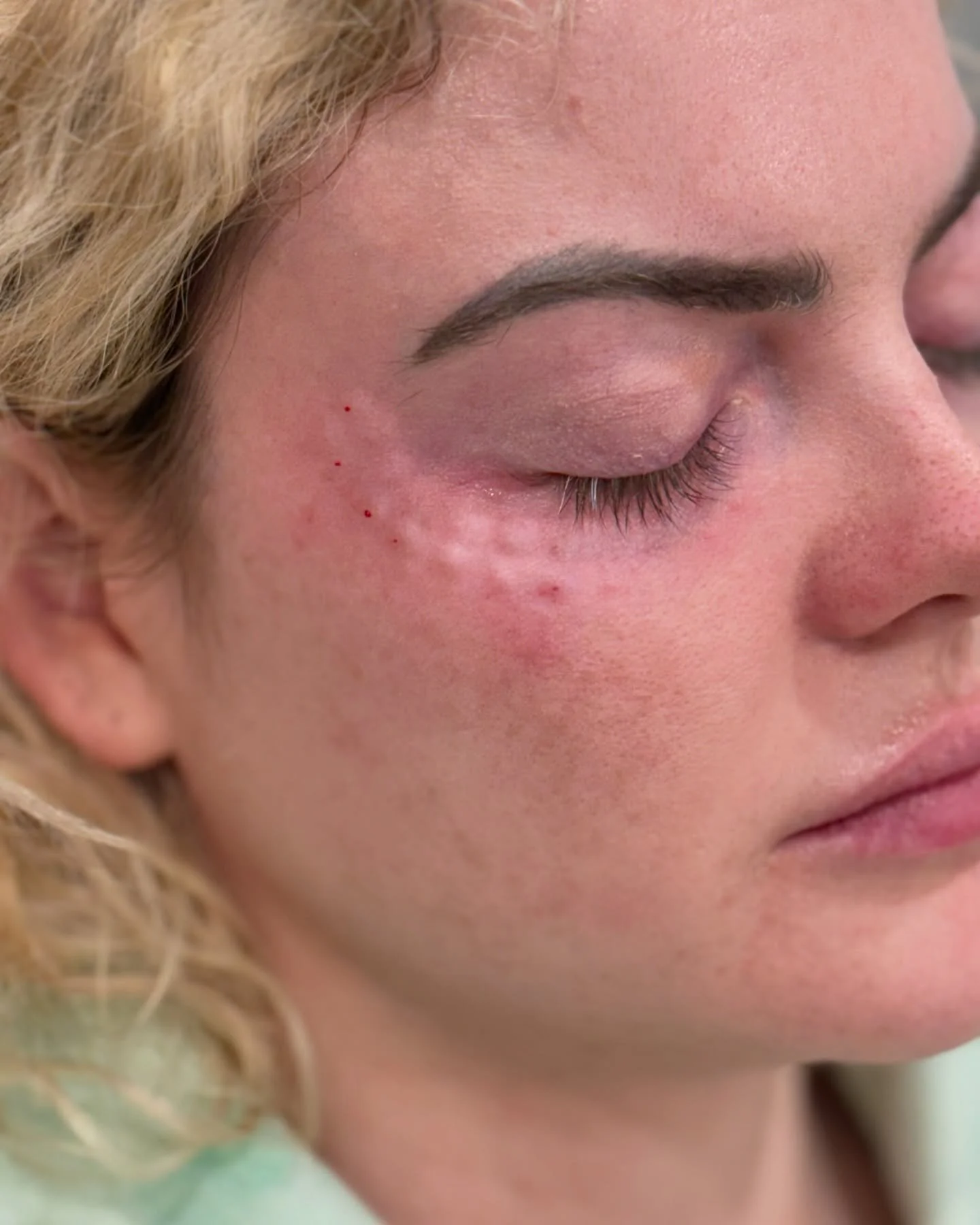 Polynucleotide under-eye treatments rejuvenate the skin by boosting collagen production, improving elasticity, and reducing fine lines and dark circles, offering a youthful and refreshed appearance. It will take a couple days for these bumps under th