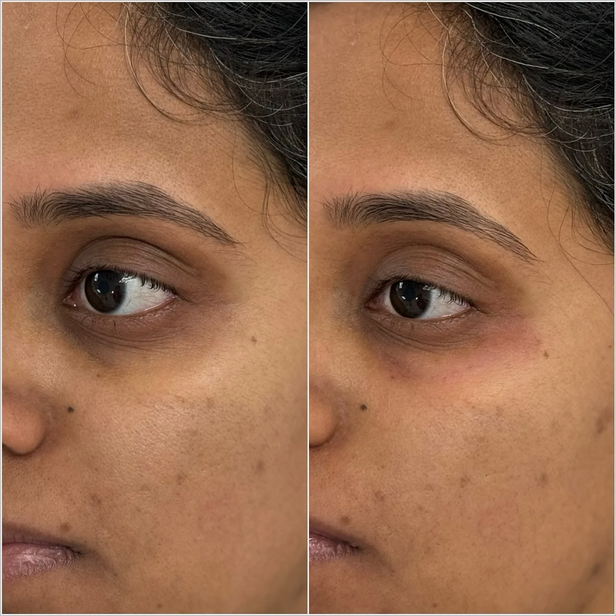 The under eye area should be under-treated rather than over-corrected to avoid complications such as puffiness or a &ldquo;pillow-like&rdquo; appearance. The delicate skin under the eyes is prone to swelling, and overfilling can exacerbate this issue