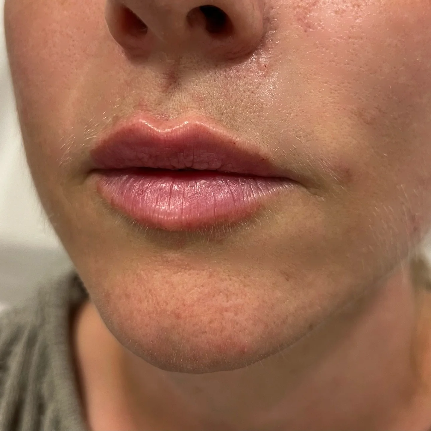 Natural lip filler treatment 👄💉