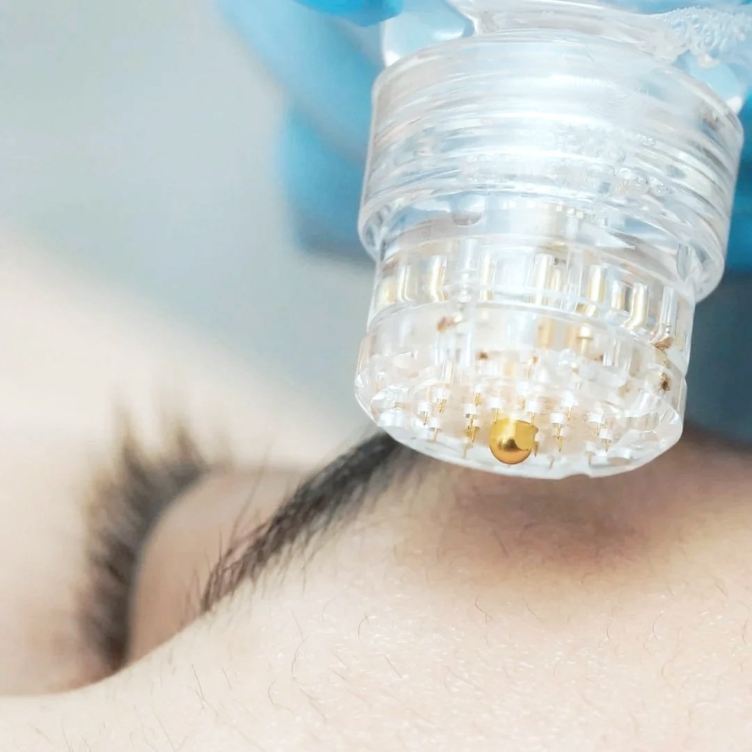 Nahaufnahme einer Mesotherapie Behandlung mit AquaGold Fine Touch.