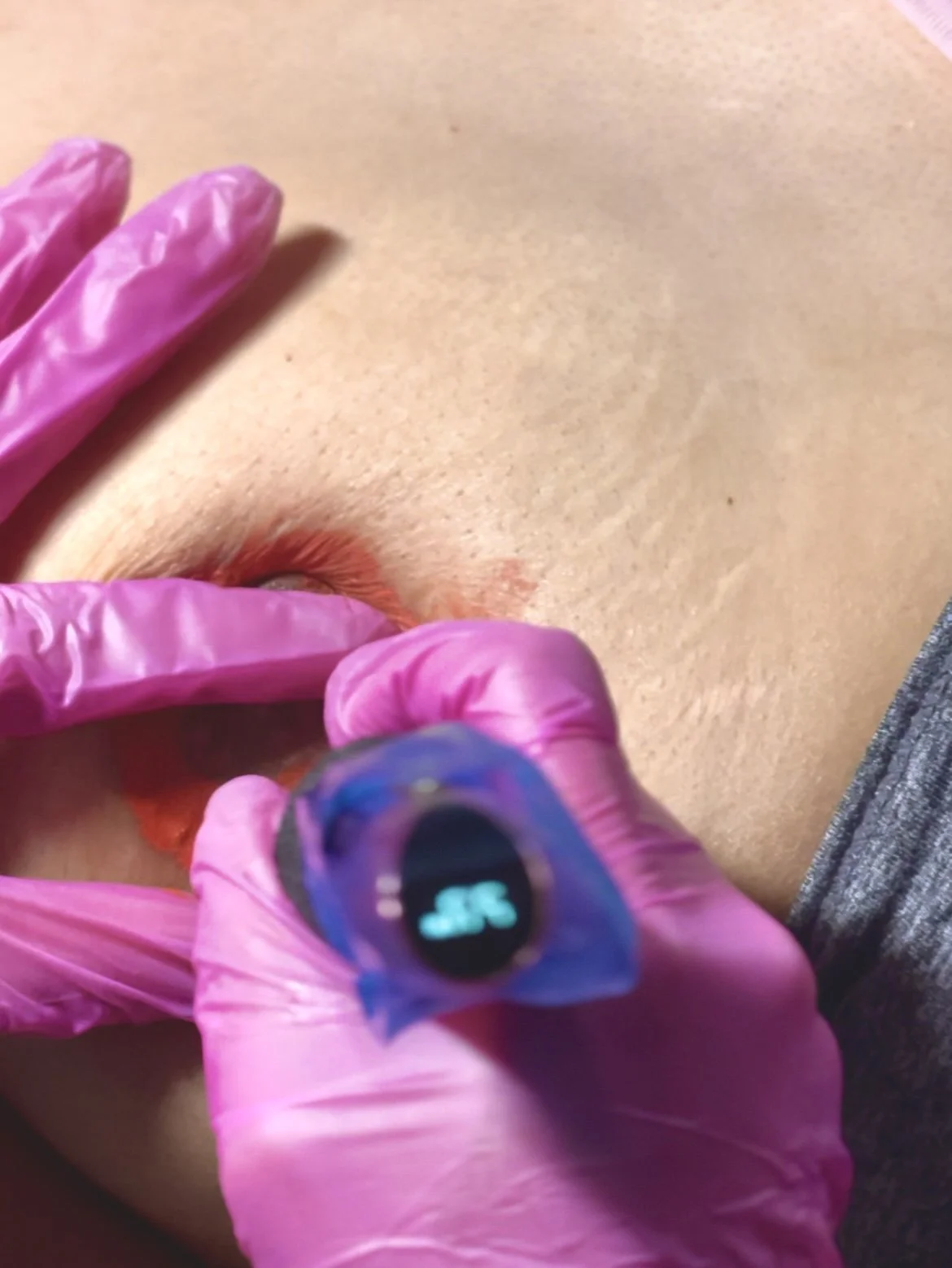 Areola Repigmentation in progress on skin with device, person wearing pink gloves.