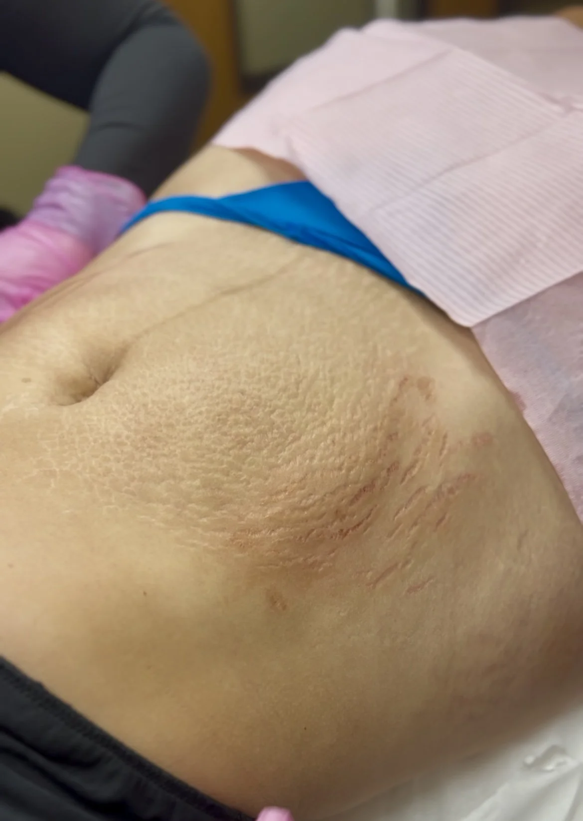 Close-up of a person's abdomen with stretch marks and pink gloves in the background.