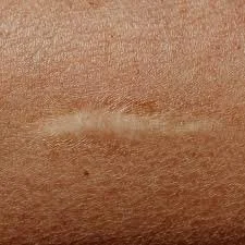 SCAR TONE PERFECTION - Small Area (Under 3