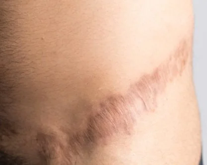 Close-up of a surgical scar on skin