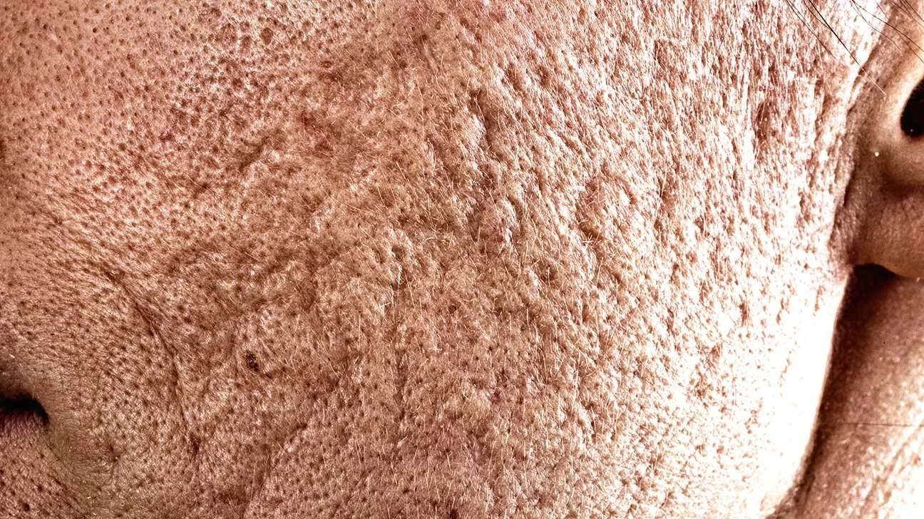 Close-up of a person's nose showing oily skin, enlarged pores, and blackheads.