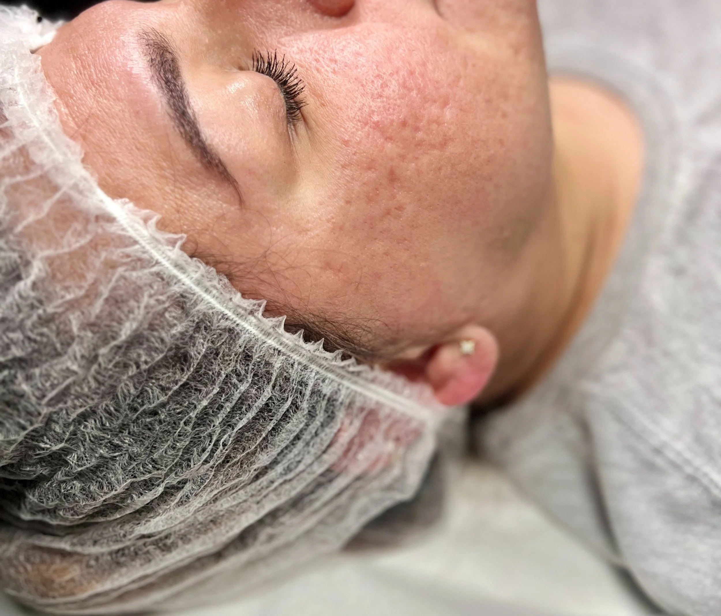 Close-up of a person's face with acne scar , wearing cap, showing textured skin and closed eyes, emphasizing skincare or dermatology.