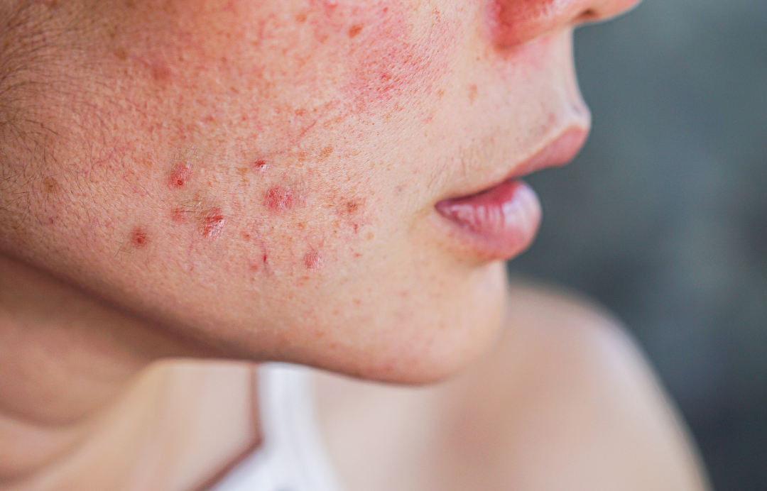 Acne Após Parar a Pílula: Causas e Sintomas