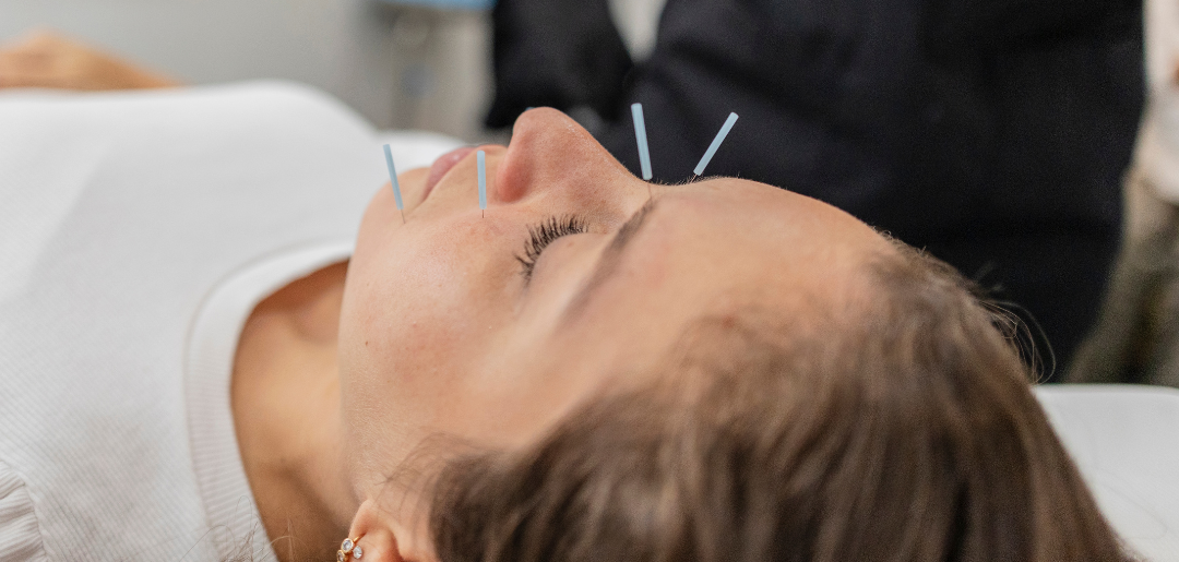 Acupuntura Facial: uma abordagem integrativa para a saúde e vitalidade da pele