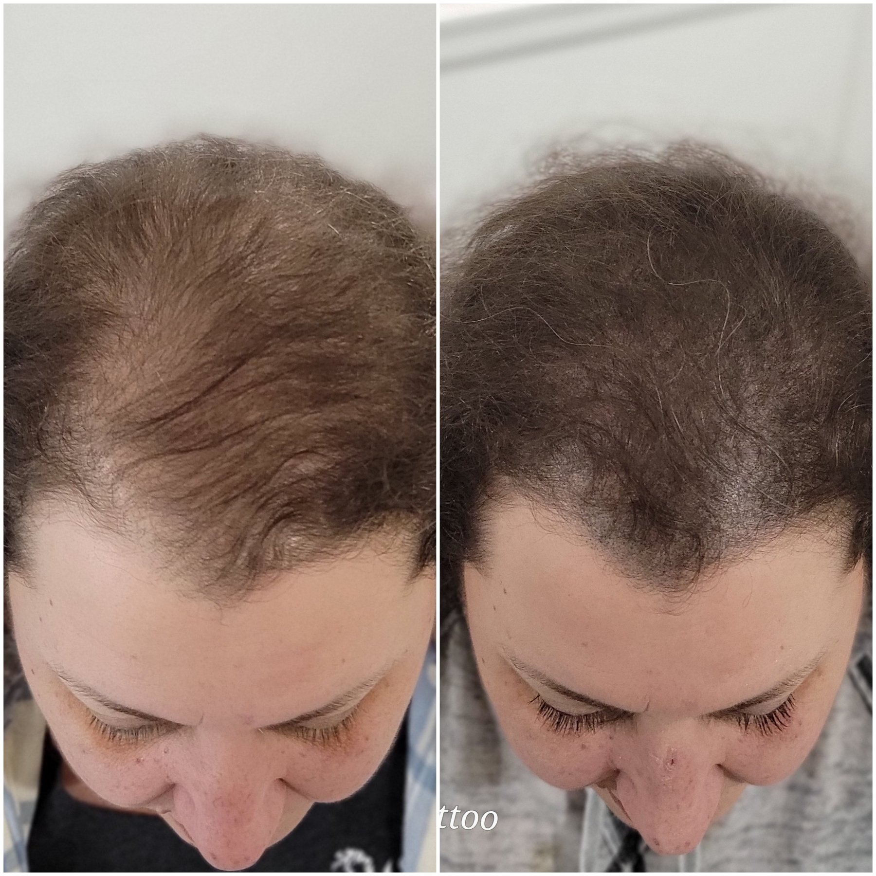 scalp-micro-pigmentation-women.jpg