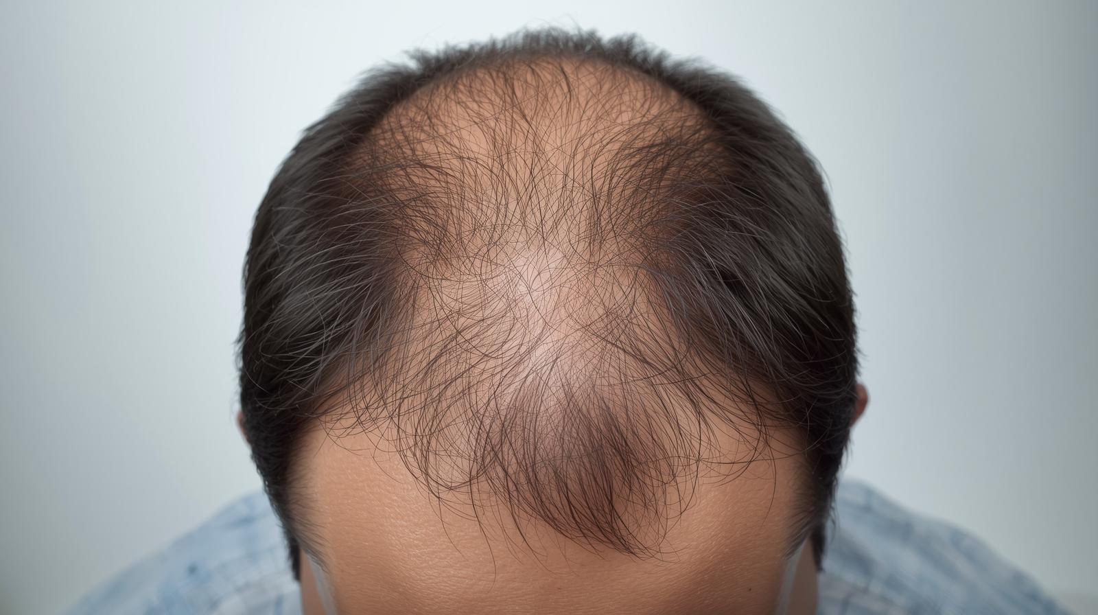 From stress, to genetics, to weight loss or postpartum hair loss, we help you with it all.