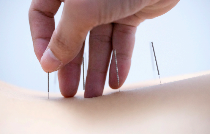 Close-up of licensed acupuncturist gently placing sterile acupuncture needles into a patient’s skin, demonstrating a safe, precise, and minimally invasive acupuncture treatment for pain relief and nervous system support.