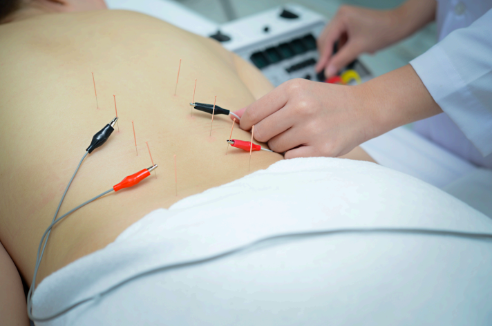This image depicts electroacupuncture being applied to the back by a an experienced practitioner helping reduce chronic pain symptoms in a safe and effective way.