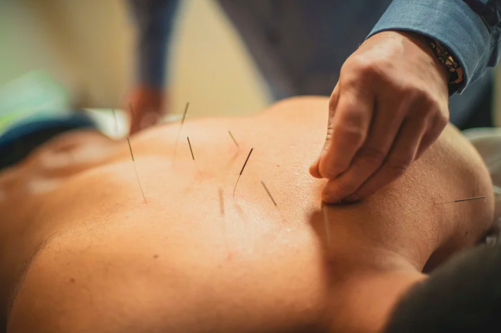 Image showing acupuncture treatment on the back as supportive and complimentary care for back pain