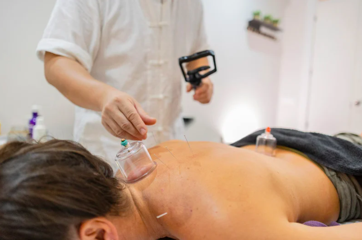 Image of a person receiving cupping and acupuncture for relief of pain in the neck and shoulders and low back from an expert practitioner