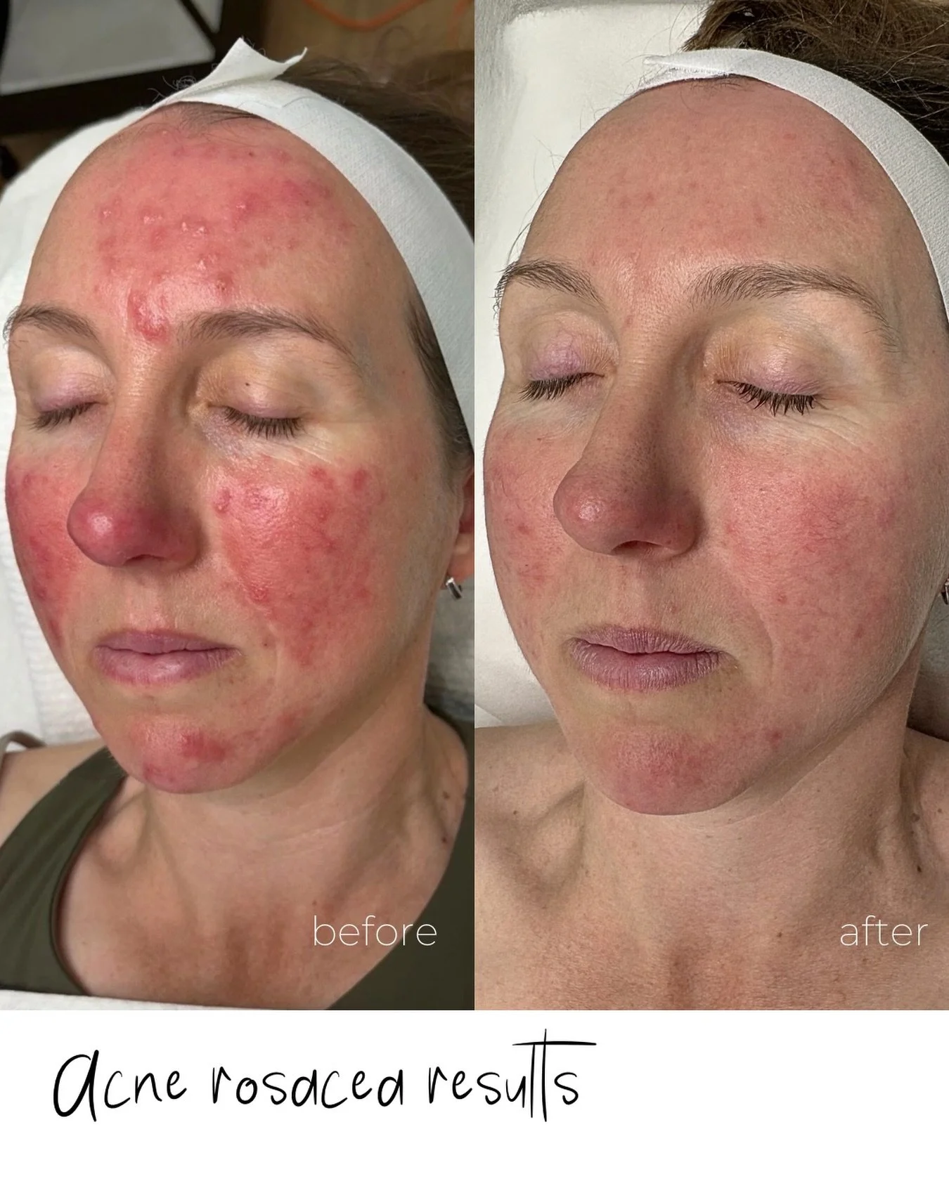 This beautiful client sat in our chair feeling like her skin had betrayed her. She was feeling a little insecure. She tried EVERYTHING. The creams, dermatologists, GP&rsquo;s and nothing worked.

We were her last resort. 

Rosacea. Acne. A skin barri