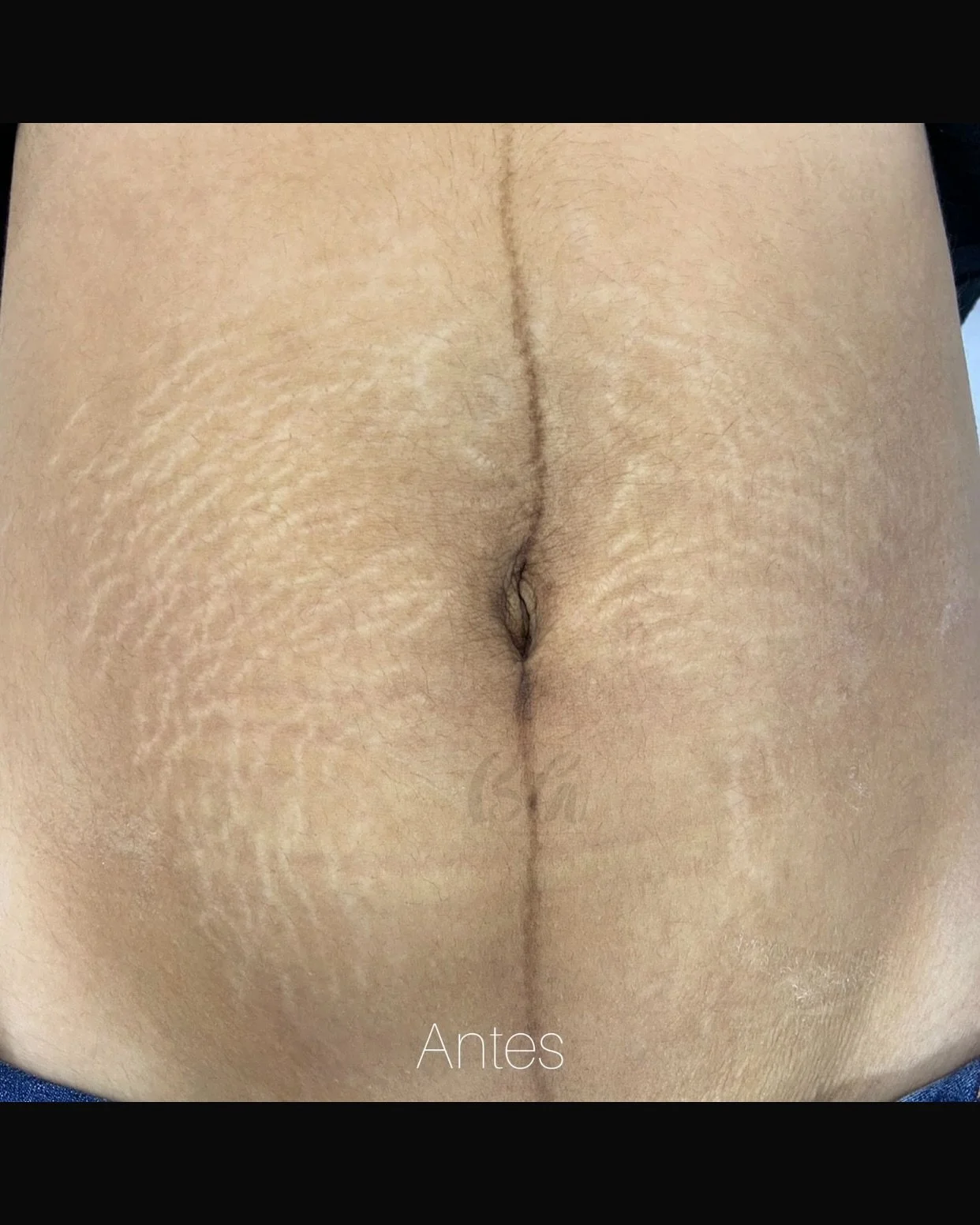 Trazendo mais um resultado incr&iacute;vel do M&eacute;todo B&aacute;rbara Aguiar pra voc&ecirc;s! 
Foram 3 sess&otilde;es para obter esse resultado perfeito.

E voc&ecirc; tem um desejo de realizar o tratamento? 
Entre em contato conosco que n&oacut