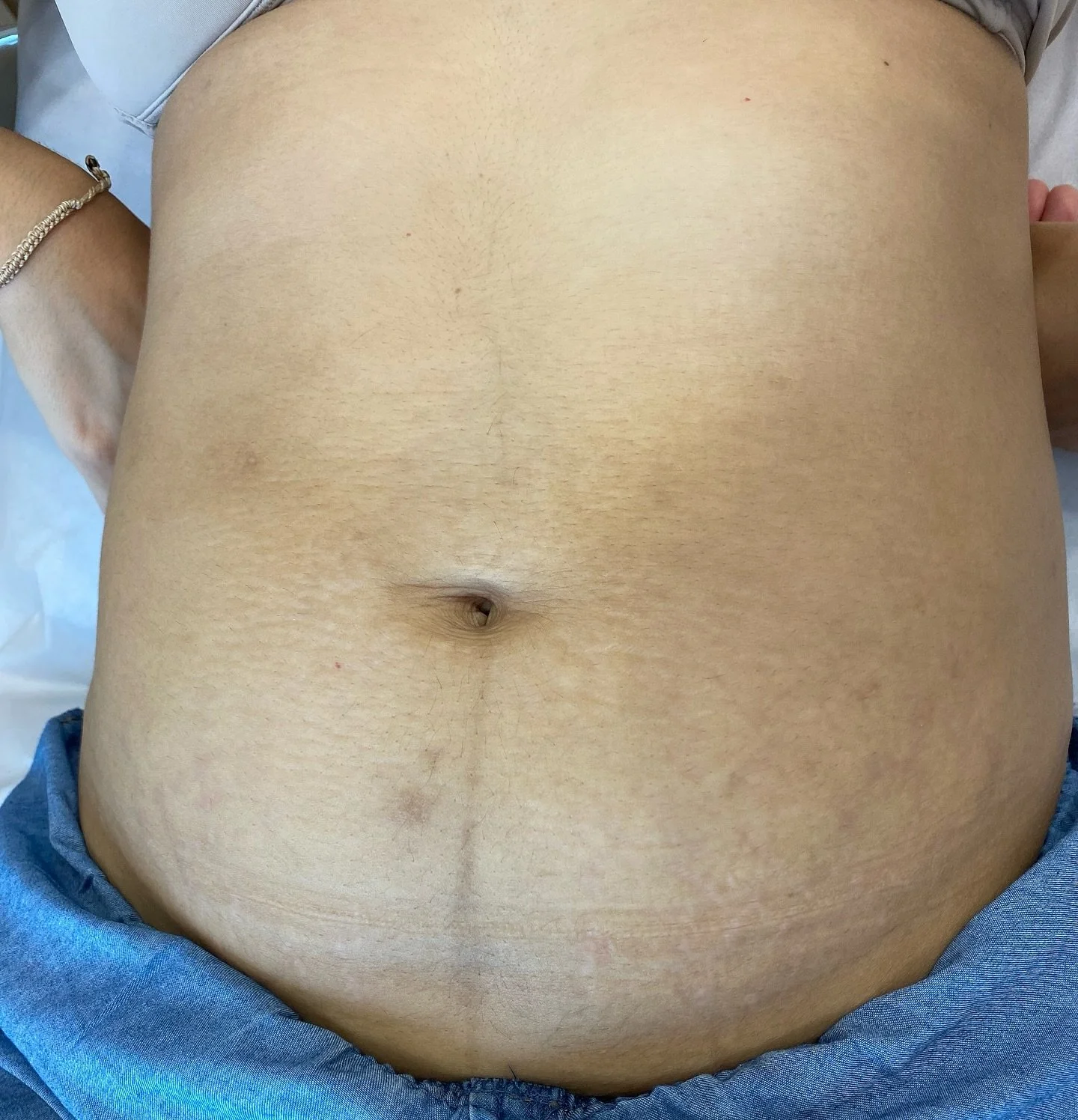 Resultado de apenas uma sess&atilde;o, paciente em tratamento. 

Estrias brancas p&oacute;s parto, indicado 3 sess&otilde;es. 

#estriasbrancas #cuidado #autoestima #estriasnagravidez #tratamentoparaestrias #sjc #jacarei #taubate #pindamonhangaba_sp 