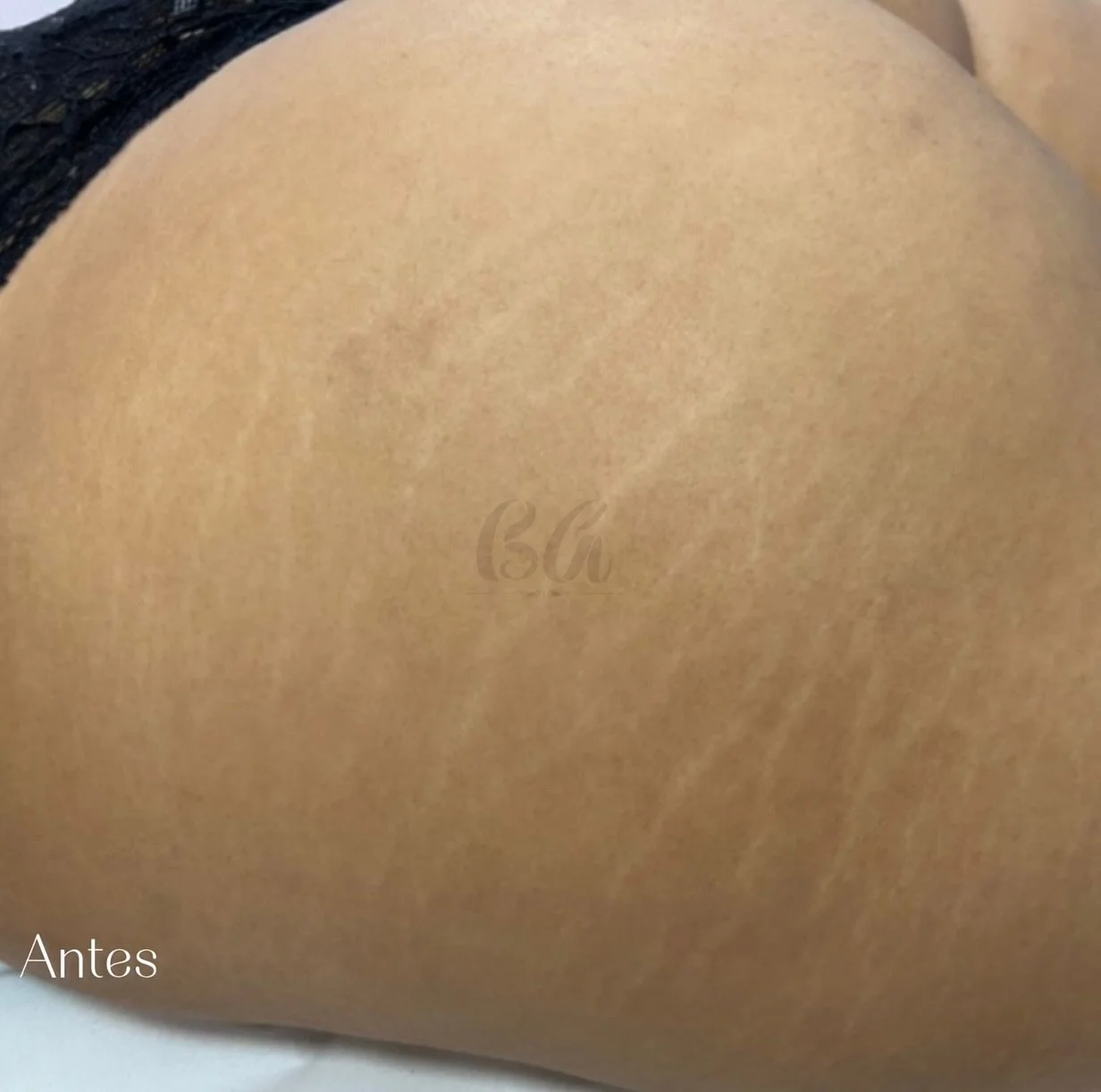 Olhem s&oacute; esse caso  de estrias brancas em gl&uacute;teos, protocolo finalizado de 3 sess&otilde;es! ✨
Paciente liberada pra ir &agrave; praia, feliz e com sua autoestima renovada! 

Voc&ecirc; quer saber mais sobre o tratamento para estrias ? 