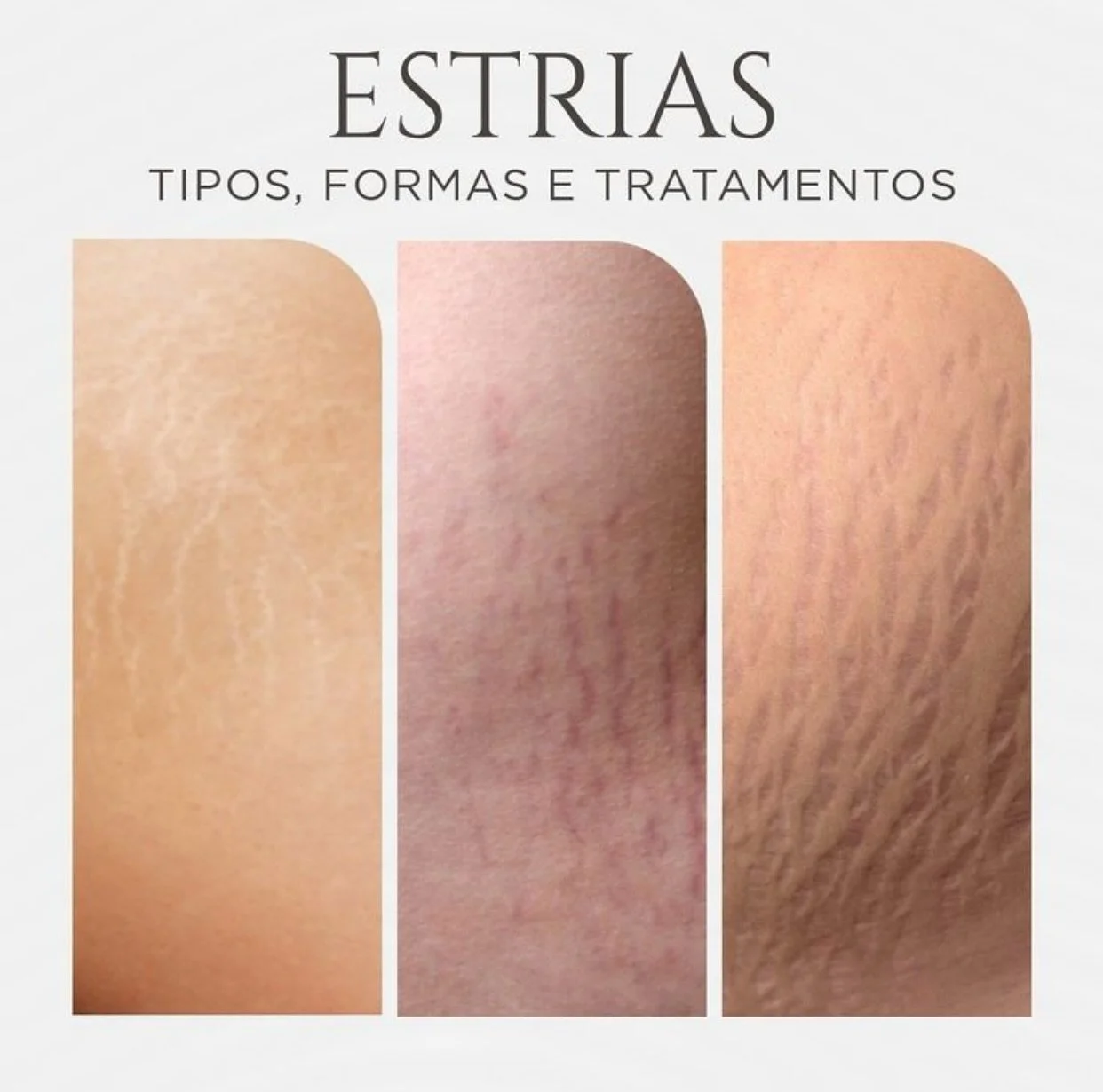 ✨ Voc&ecirc; sabia que existem diferentes tipos de estrias?
🔴 Estrias vermelhas &ndash; s&atilde;o mais recentes e ainda em fase inflamat&oacute;ria.
🤎 Estrias marrons &ndash; surgem em tons mais escuros, geralmente em peles morenas e negras.
⚪ Est