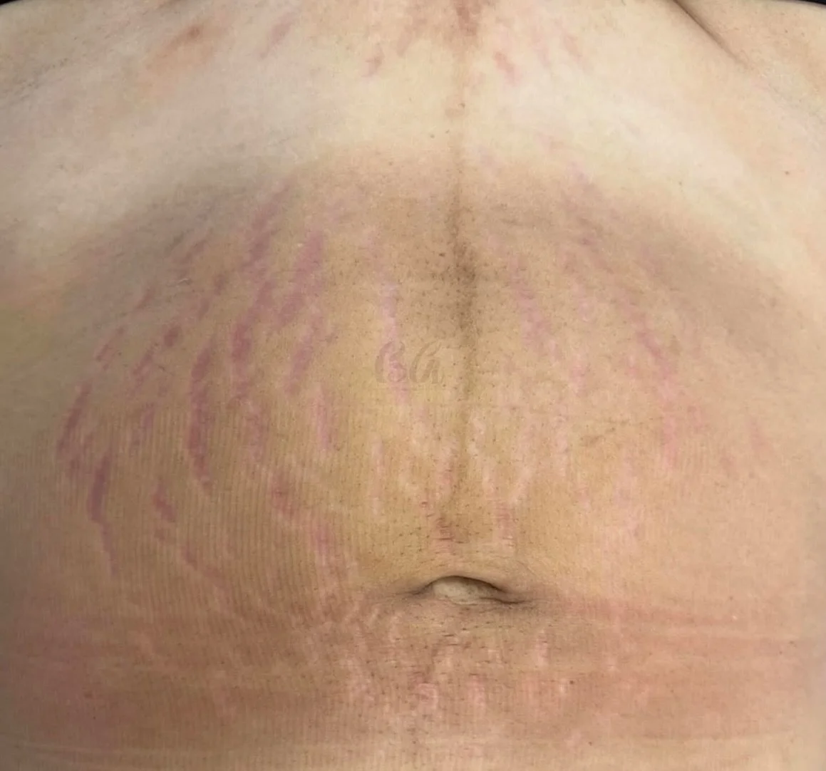 ✨ Resultado real do nosso protocolo exclusivo, paciente ainda em tratamento ✨

As estrias vermelhas j&aacute; n&atilde;o s&atilde;o mais um problema! 💖
Com o M&eacute;todo B&aacute;rbara Aguiar, voc&ecirc; conquista uma pele mais uniforme, firme e r