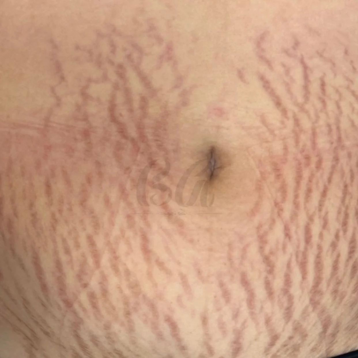 🔴 Antes: Estrias vermelhas evidentes, marcando a pele e trazendo inc&ocirc;modo est&eacute;tico para a paciente.
🌸 Depois: Estrias visivelmente suavizadas, com colora&ccedil;&atilde;o mais clara e textura mais uniforme, revelando resultados incr&ia