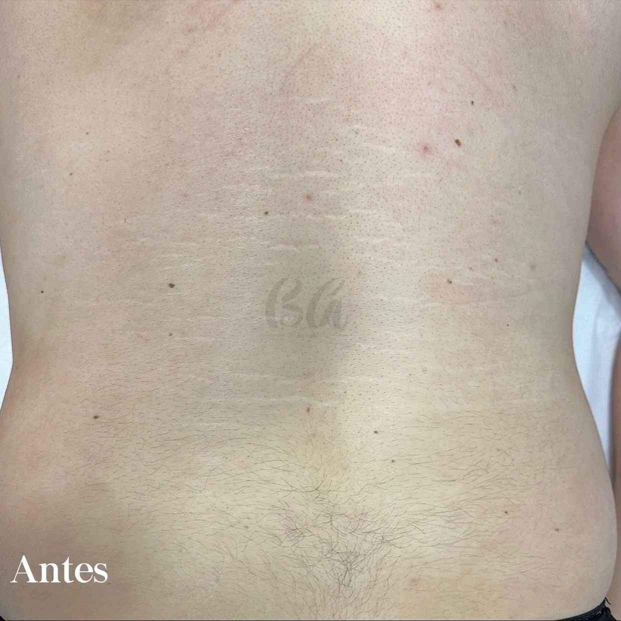 As estrias brancas podem parecer permanentes, mas com o tratamento do M&eacute;todo B&aacute;rbara Aguiar &eacute; poss&iacute;vel recuperar a textura e a uniformidade da pele. 💪

Este &eacute; o resultado de apenas 1 sess&atilde;o do tratamento per