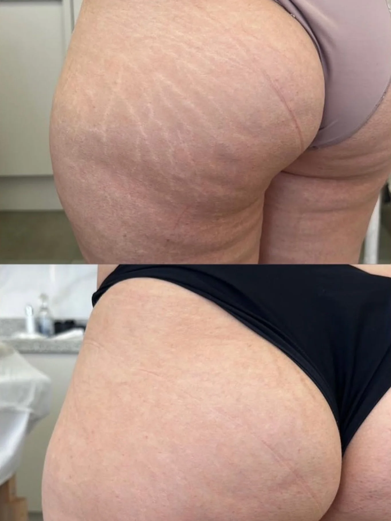 N&atilde;o &eacute; vaidade. &Eacute; reconstru&ccedil;&atilde;o!
Estrias n&atilde;o s&atilde;o s&oacute; marcas f&iacute;sicas. S&atilde;o marcas na autoestima. E trat&aacute;-las &eacute; devolver algo que foi tirado. Aqui come&ccedil;amos pela con