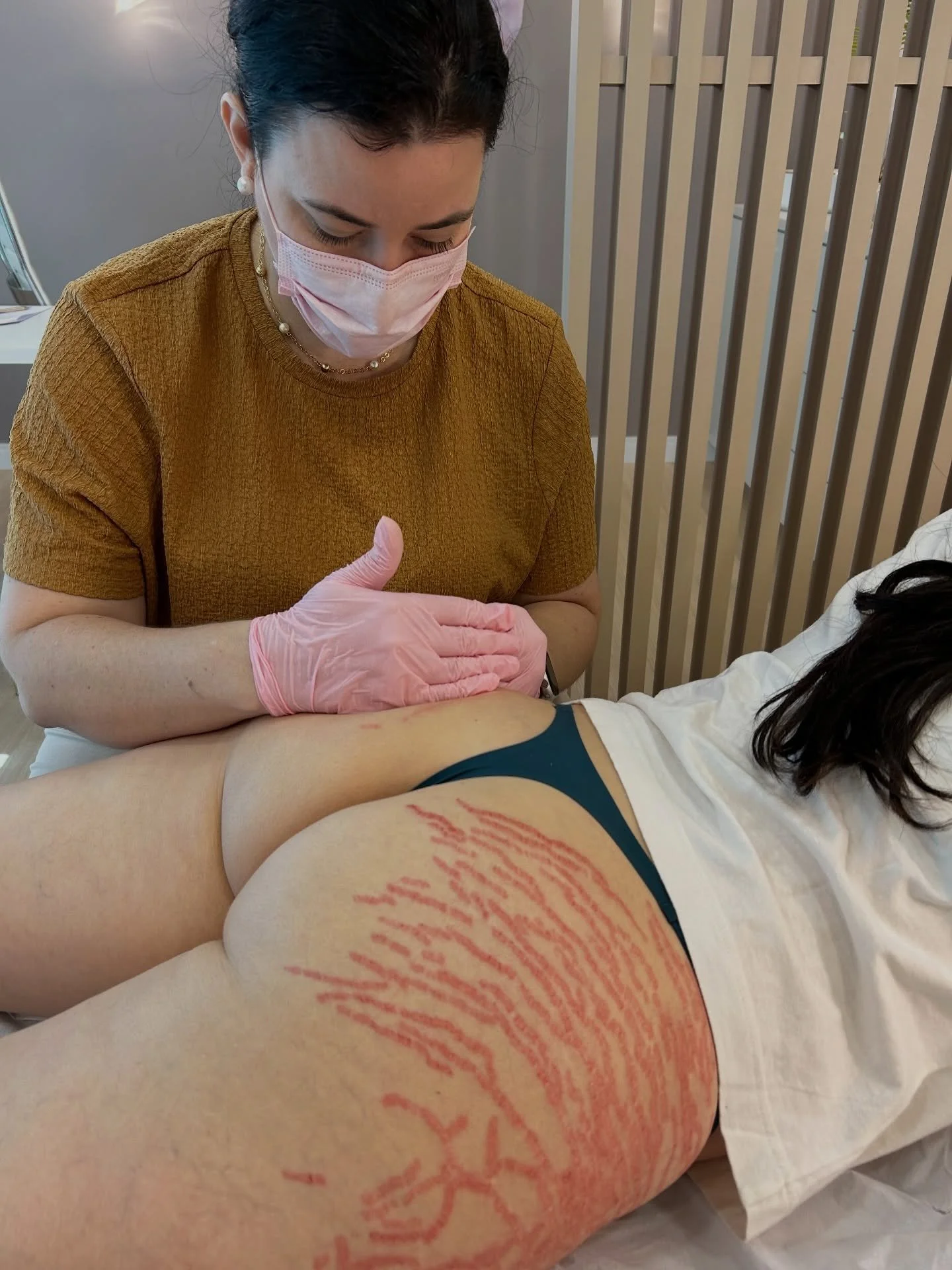 ✨ Cada marca conta uma hist&oacute;ria &mdash; e n&oacute;s cuidamos dela com respeito e ci&ecirc;ncia. ✨

Tratamento de estrias realizado com t&eacute;cnica avan&ccedil;ada, est&iacute;mulo profundo de col&aacute;geno e um protocolo pensado exclusiv