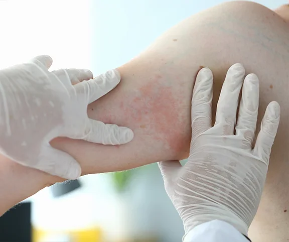 Atopic Dermatitis Research Study