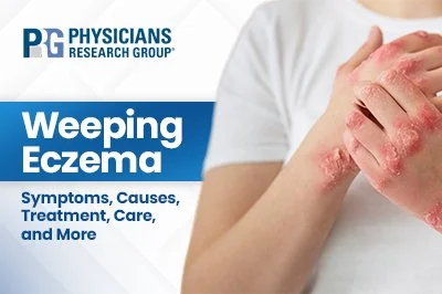 Weeping Eczema: Symptoms, Causes, Treatment, Care, and More