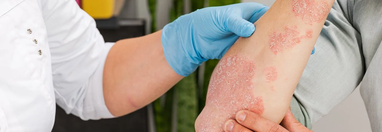 What to Expect in an Atopic Dermatitis Clinical Trials