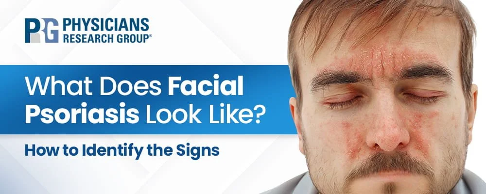 What does Facial Psoriasis look like on the Face