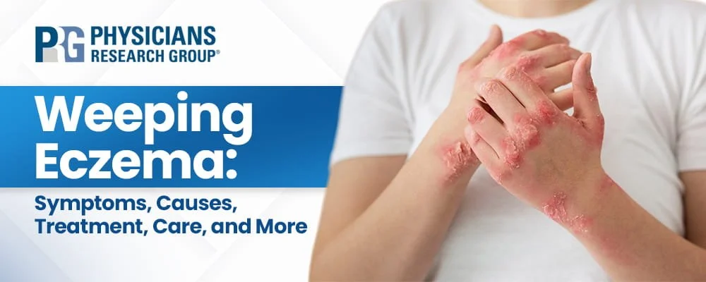 Weeping Eczema: Symptoms, Causes, Treatment, Care, and More