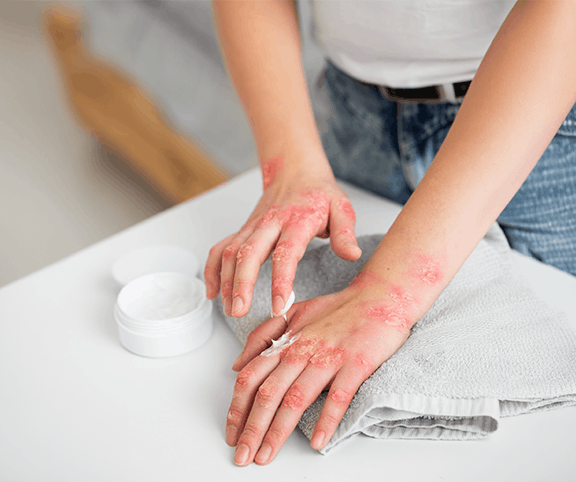 What is Atopic Dermatitis